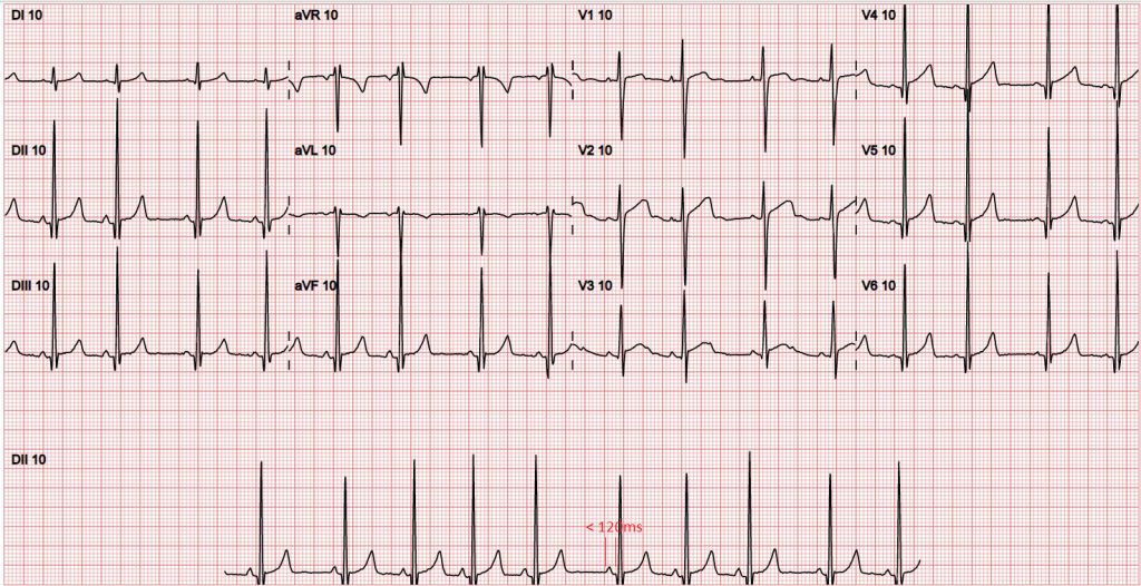 eletrocardiograma normal