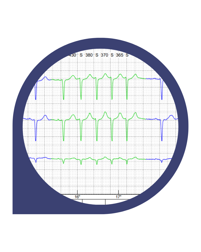 Eletrocardiograma Holter