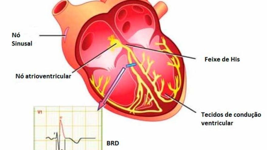 bloqueio-de-ramo-direito-do-conceito-ao-diagnostico