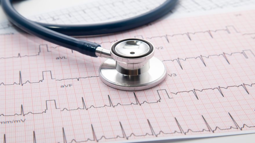 Blue Stethoscope on electrocardiogram (ECG) chart paper. ECG hea