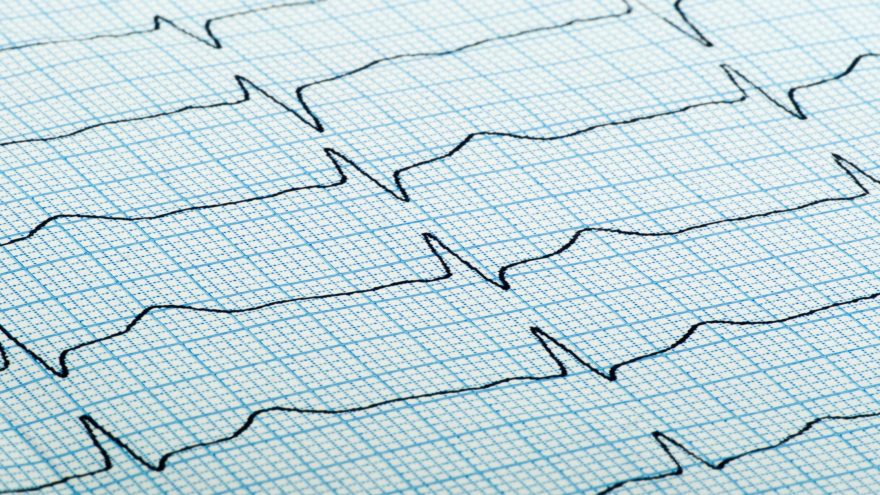 cardiogram of heart beat