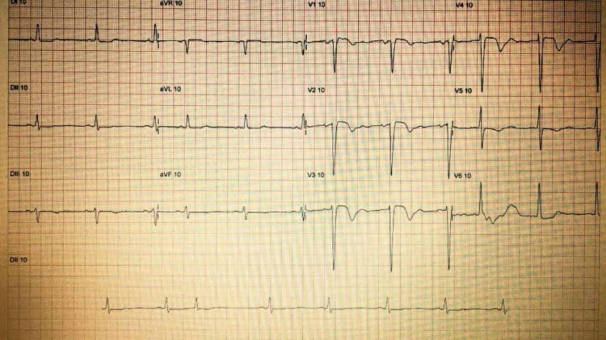 como-diagnosticar-sobrecarga-ventricular-esquerda