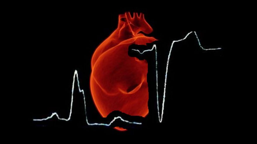 criterios-de-sgarbossa-como-diagnosticar-IAM-em-pacientes-com-BRE