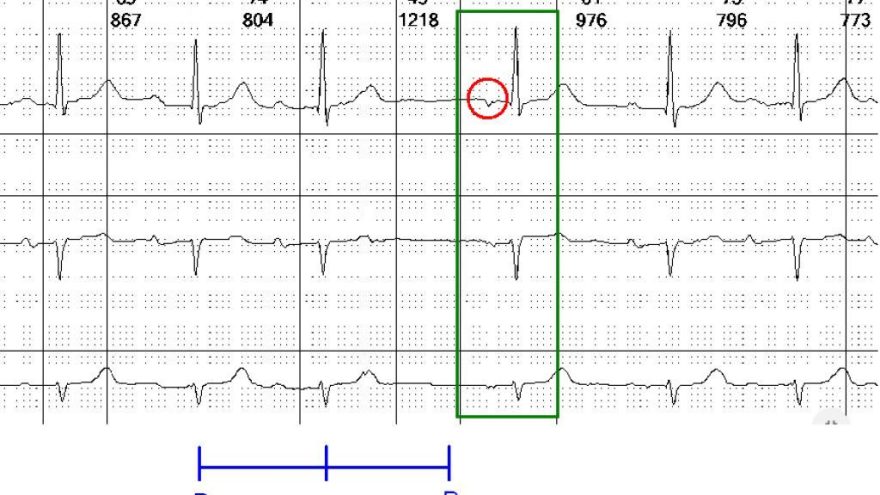 existe-escape-atrial