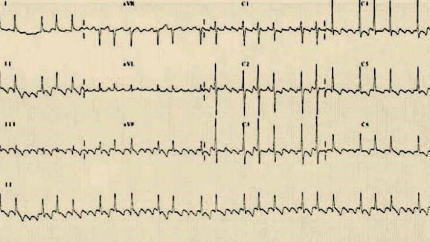 flutter_atrial