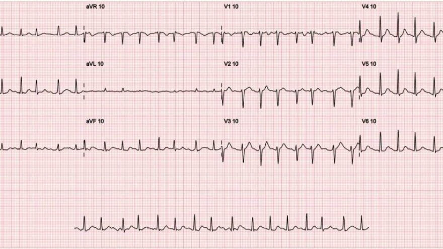 meu-paciente-tem-arritmia-sera-fibrilacao-atrial