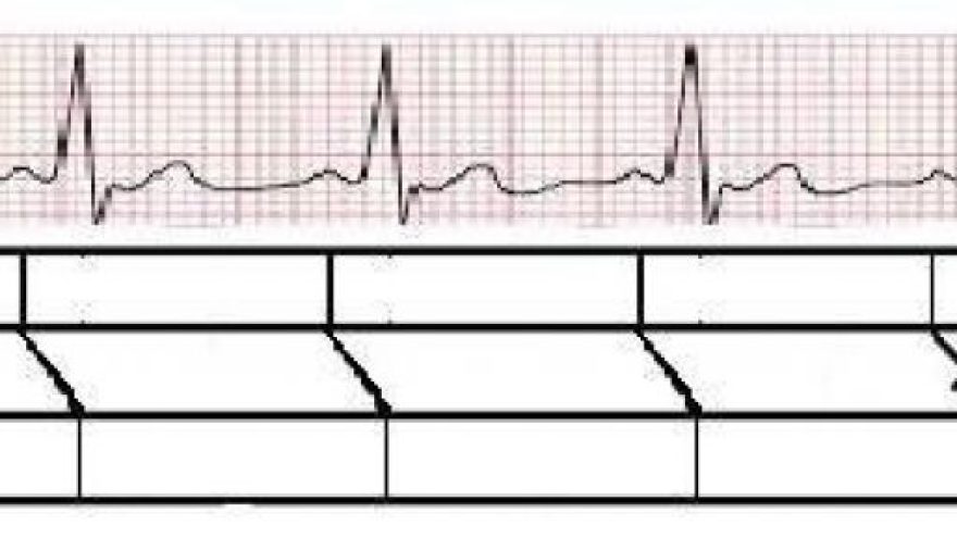 voce-sabe-o-que-e-um-bloqueio-atrioventricular